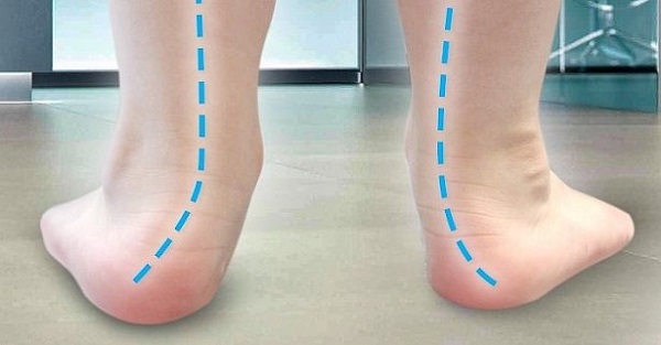 Phương pháp điều trị bàn chân bẹt và vẹo cột sống